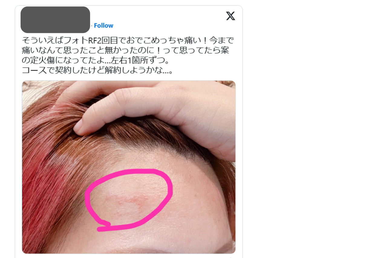 フォトRF 口コミ